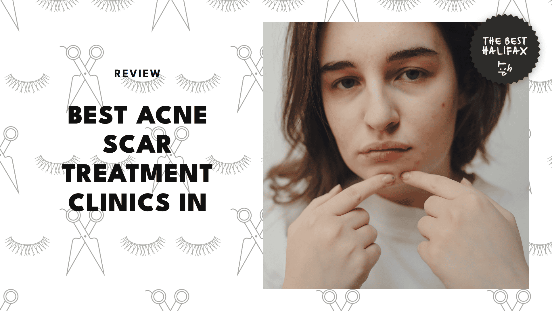 best-acne-scar-treatments-halifax